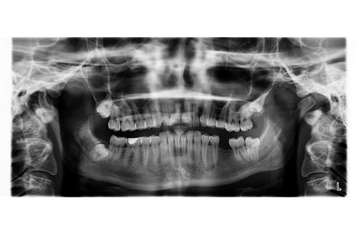 Dental X-ray machine detection model